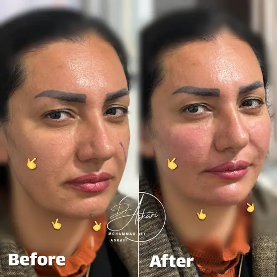 فیلر گونه اصلاح فرم چانه و گپ چانه، قبل و بعد، کلینیک زیبایی دکتر عسکری