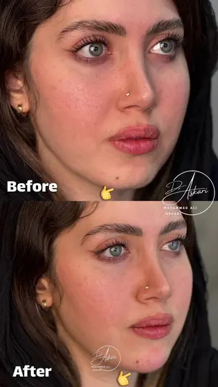 فیلر چانه اصلاح فرم چانه، قبل و بعد، کلینیک زیبایی دکتر عسکری