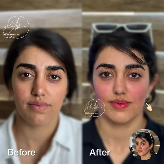 تزریق Mid Face (اهرم دوم زیبایی چهره) + تزریق میکرو در ناحیه چانه، قبل و بعد، کلینیک زیبایی دکتر عسکری