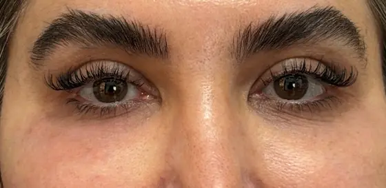 بلافاصله بعد از تزریق دیمونو یک سمت زیر چشم تفاوت ناحیه زیر چشم چپ و راست رو، قبل و بعد، کلینیک زیبایی دکتر عسکری