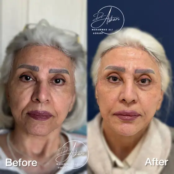 اصلاح خط خنده، اصلاح چانه و گپ چانه، جوان‌سازی با تزریق مزوژل، جوان‌سازی لب، قبل و بعد، کلینیک زیبایی دکتر عسکری