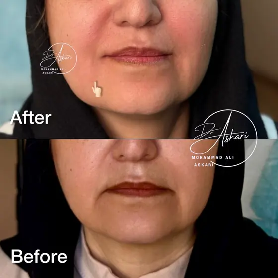 فیلر خط اندوه، قبل و بعد، کلینیک زیبایی دکتر عسکری