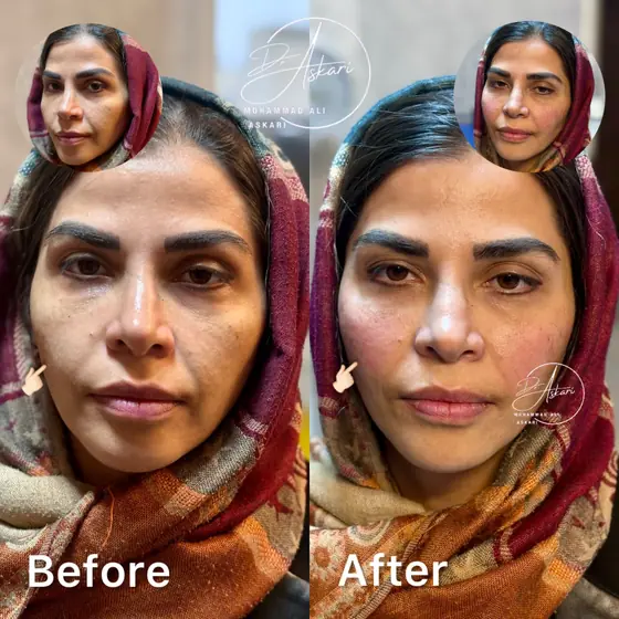 فیلر گونه – احیای جوانی صورت، قبل و بعد، کلینیک زیبایی دکتر عسکری