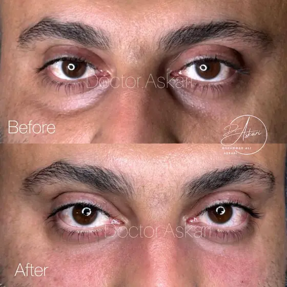 فیلر زیرچشم رفع گودی زیرچشم، قبل و بعد، کلینیک زیبایی دکتر عسکری