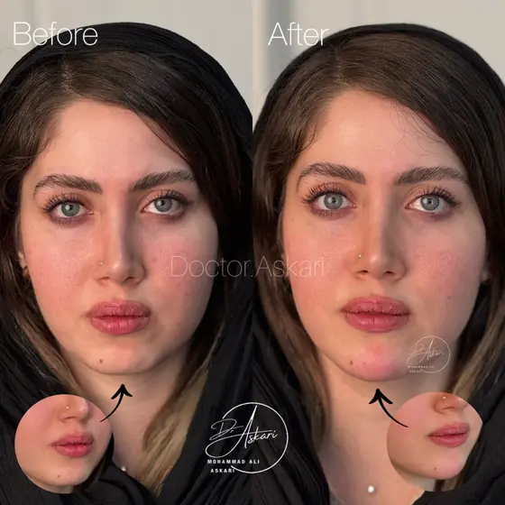 فیلر چانه، قبل و بعد، کلینیک زیبایی دکتر عسکری
