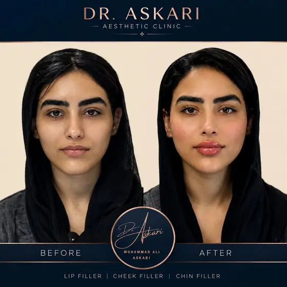 فیلر لب فیلر گونه و چانه اصلاح فرم صورت، قبل و بعد، کلینیک زیبایی دکتر عسکری