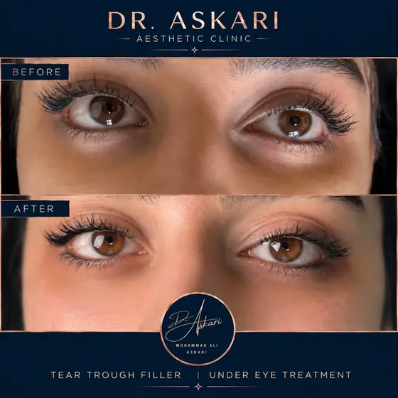 تزریق فیلر زیرچشم – رفع گودی ناحیهٔ زیرچشم با فیلر الیاکسین (Aliaxin)، قبل و بعد، کلینیک زیبایی دکتر عسکری