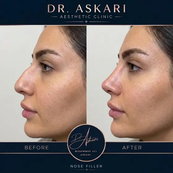 فیلر بینی اصلاح طبیعی فرم بینی بدون جراحی، قبل و بعد، کلینیک زیبایی دکتر عسکری