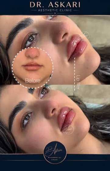 فیلر لب، قبل و بعد، کلینیک زیبایی دکتر عسکری