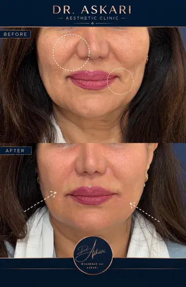 فیلر خط خنده و فیلر خط اندوه تغییر طبیعی و نچرال، قبل و بعد، کلینیک زیبایی دکتر عسکری